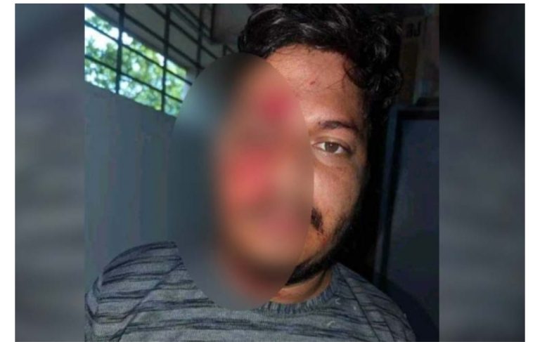 মীরসরাইয়ে পাগলা কুকুরের কামড়ে ২০ জন আহত