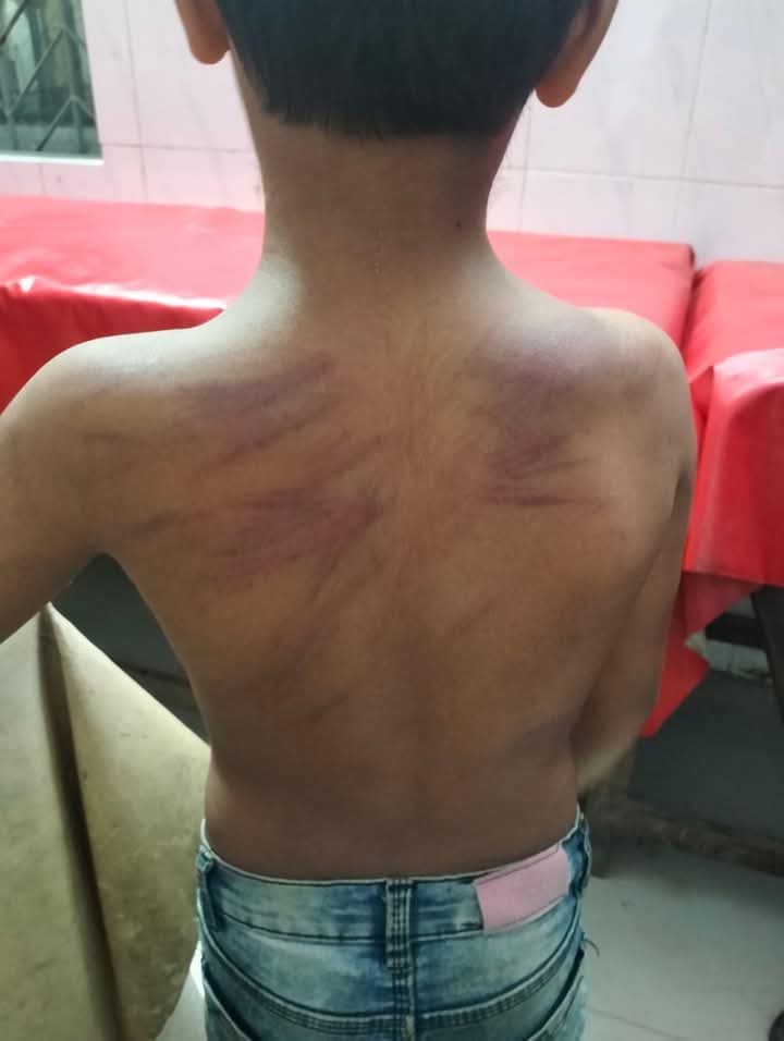 সহকারী শিক্ষকের বেত্রাঘাতে গুরুতর আহত শিক্ষার্থী