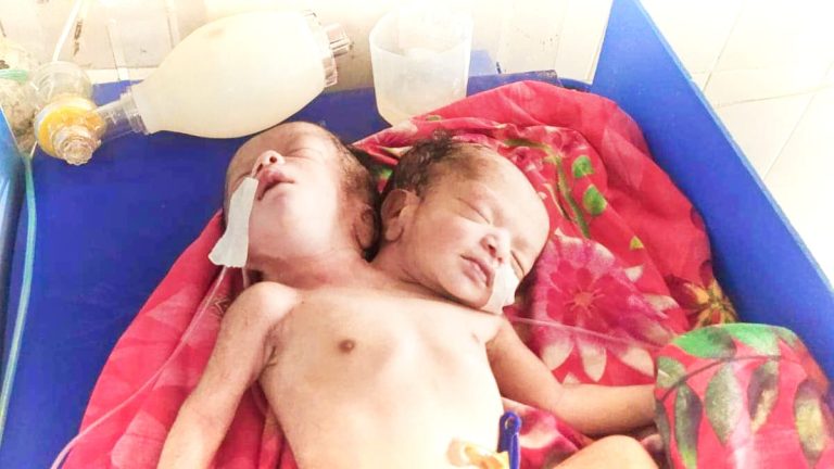 পঞ্চগড়ে দুই মাথা নিয়ে জন্ম নিলেন শিশু