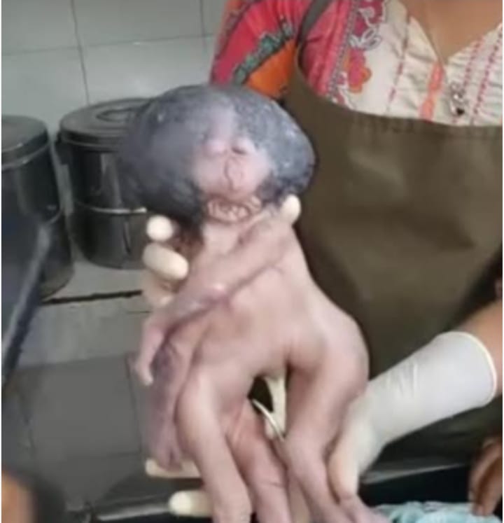 নাটোরে অদ্ভুত আকৃতির জোড়া লাগানো দুই শিশুর জন্ম